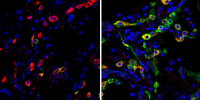 images of lung cells, from healthy donor and COVID patients